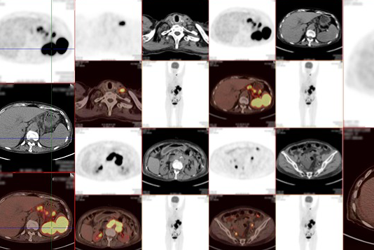 云泰案例 | 不明原因发热？PET/CT揪出“元凶”